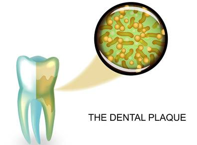 dental plaque